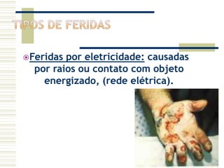 Feridas por eletricidade: causadas
por raios ou contato com objeto
energizado, (rede elétrica).
 
