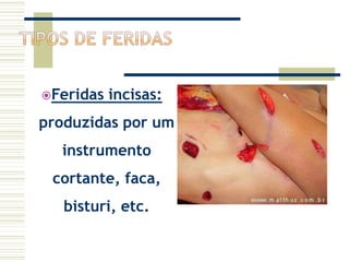 Feridas incisas:
produzidas por um
instrumento
cortante, faca,
bisturi, etc.
 
