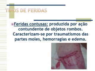 Feridas contusas: produzida por ação
contundente de objetos rombos.
Caracterizam-se por traumatismos das
partes moles, hemorragias e edema.
 
