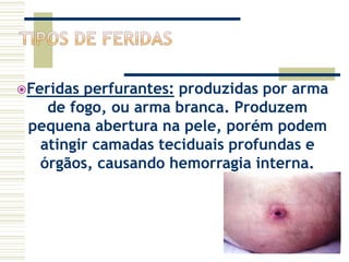 Feridas perfurantes: produzidas por arma
de fogo, ou arma branca. Produzem
pequena abertura na pele, porém podem
atingir camadas teciduais profundas e
órgãos, causando hemorragia interna.
 