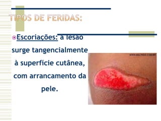 Escoriações: a lesão
surge tangencialmente
à superfície cutânea,
com arrancamento da
pele.
 