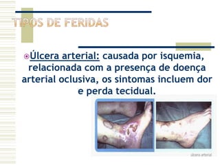 Úlcera arterial: causada por isquemia,
relacionada com a presença de doença
arterial oclusiva, os sintomas incluem dor
e perda tecidual.
 