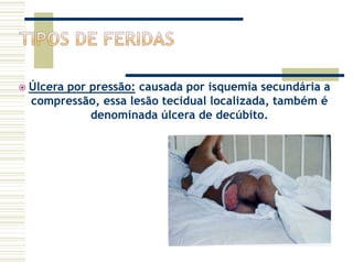  Úlcera por pressão: causada por isquemia secundária a
compressão, essa lesão tecidual localizada, também é
denominada úlcera de decúbito.
 