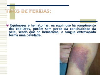  Equimoses e hematomas: na equimose há rompimento
dos capilares, porém sem perda da continuidade da
pele, sendo que no hematoma, o sangue extravasado
forma uma cavidade.
 