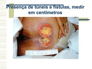Presença de túneis e fístulas, medir
em centímetros
 