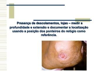 Presença de descolamentos, lojas – medir a
profundidade e extensão e documentar a localização
usando a posição dos ponteiros do relógio como
referência.
 