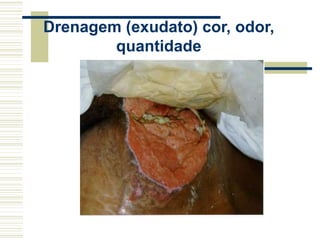Drenagem (exudato) cor, odor,
quantidade
 