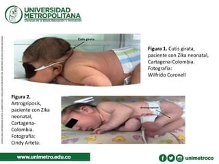 Figura 1. Cutis girata,
paciente con Zika neonatal,
Cartagena-Colombia.
Fotografia:
Wilfrido Coronell
Figura 2.
Artrogriposis,
paciente con Zika
neonatal,
Cartagena-
Colombia.
Fotografia:
Cindy Arteta.
 