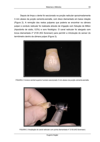 Materiais e Métodos
Eugenio Kegler
63
Depois de limpo o dente foi seccionado na porção radicular aproximadamente
3 mm abaixo da junção cemento-esmalte, com disco diamantado em baixa rotação
(Figura 2). A remoção dos restos pulpares que poderia se encontrar na câmara
pulpar e conduto radicular foi realizada através de irrigação com Solução de Milton
(hipoclorito de sódio, 0,5%) e soro fisiológico. O canal radicular foi alargado com
broca diamantada nº 2135 (KG Sorensen) para permitir a introdução do sensor do
termômetro dentro da câmara pulpar (Figura 3).
FIGURA 2: Incisivo central superior humano seccionado 3 mm abaixo da junção cemento-esmalte.
FIGURA 3: Ampliação do canal radicular com ponta diamantada nº 2135 (KG Sorensen)
 