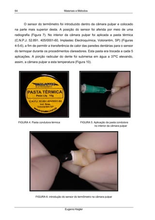 Materiais e Métodos
Eugenio Kegler
64
O sensor do termômetro foi introduzido dentro da câmara pulpar e colocado
na parte mais superior desta. A posição do sensor foi aferida por meio de uma
radiografia (Figura 7). No interior da câmara pulpar foi aplicada a pasta térmica
(C.N.P.J. 52.891. 405/0001-60, Implastec Electroquímica, Votorantim, SP) (Figuras
4-5-6), a fim de permitir a transferência de calor das paredes dentárias para o sensor
do termopar durante os procedimentos clareadores. Esta pasta era trocada a cada 5
aplicações. A porção radicular do dente foi submersa em água a 37ºC elevando,
assim, a câmara pulpar a esta temperatura (Figura 10).
FIGURA 4: Pasta condutora térmica FIGURA 5: Aplicação da pasta condutora
no interior da câmara pulpar
FIGURA 6: introdução do sensor do termômetro na câmara pulpar
 