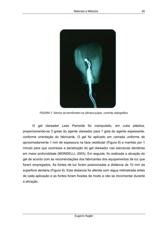 Materiais e Métodos
Eugenio Kegler
65
FIGURA 7: Sensor do termômetro na câmara pulpar, controle radiográfico
O gel clareador Lase Peroxide foi manipulado, em cuba plástica,
proporcionando-se 3 gotas do agente clareador para 1 gota do agente espessante,
conforme orientação do fabricante. O gel foi aplicado em camada uniforme de
aproximadamente 1 mm de espessura na face vestibular (Figura 8) e mantido por 1
minuto para que ocorresse a penetração do gel clareador nas estruturas dentárias
em maior profundidade (MONDELLI, 2003). Em seguida, foi realizada a ativação do
gel de acordo com as recomendações dos fabricantes dos equipamentos de luz que
foram empregados. As fontes de luz foram posicionadas a distância de 10 mm da
superfície dentária (Figura 9). Esta distancia foi aferida com régua milimetrada antes
de cada aplicação e as fontes foram fixadas de modo a não se movimentar durante
a ativação.
 