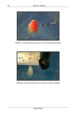 Materiais e Métodos
Eugenio Kegler
66
FIGURA 8: Controle da espessura do gel com sonda periodontal milimetrada
FIGURA 9: Controle da distancia da luz ao dente com régua milimetrada
 