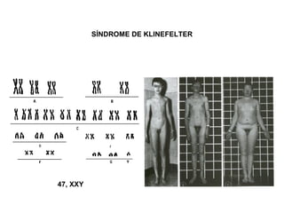 SÍNDROME DE KLINEFELTER 47, XXY   