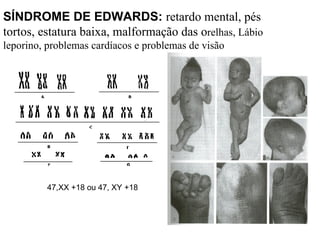 SÍNDROME DE EDWARDS:  retardo mental, pés tortos, estatura baixa, malformação das o relhas, Lábio leporino, problemas cardíacos e problemas de visão  47,XX +18 ou 47, XY +18   