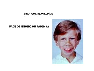 SÍNDROME DE WILLIAMS FACE DE GNÔMO OU FADINHA 