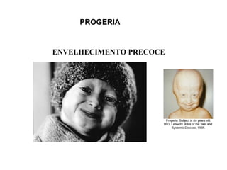 PROGERIA ENVELHECIMENTO PRECOCE 