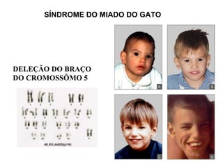 SÍNDROME DO MIADO DO GATO DELEÇÃO DO BRAÇO DO CROMOSSÔMO 5 