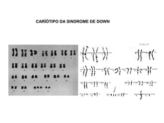CARÍÓTIPO DA SINDROME DE DOWN
 