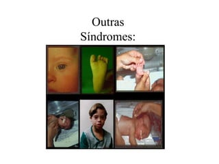 Outras
Síndromes:
 