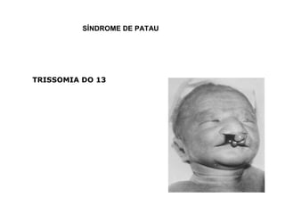 SÍNDROME DE PATAU
TRISSOMIA DO 13
 