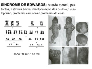 SÍNDROME DE EDWARDS: retardo mental, pés
tortos, estatura baixa, malformação das orelhas, Lábio
leporino, problemas cardíacos e problemas de visão
47,XX +18 ou 47, XY +18
 