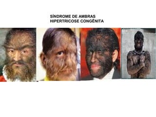 SÍNDROME DE AMBRAS
HIPERTRICOSE CONGÊNITA
 