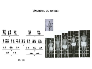 SÍNDROME DE TURNER
45, X0
 