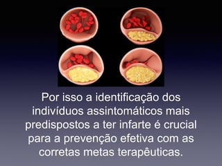 Por isso a identificação dos
indivíduos assintomáticos mais
predispostos a ter infarte é crucial
para a prevenção efetiva com as
corretas metas terapêuticas.
 