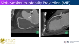 Coronary calcium patterns detected with Computed Tomography and their ...