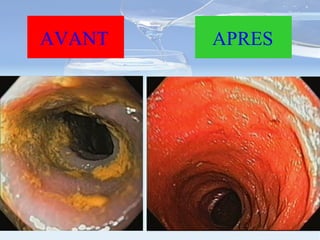 AVANT APRES 