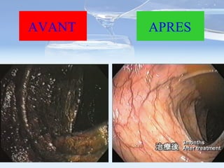 AVANT APRES 