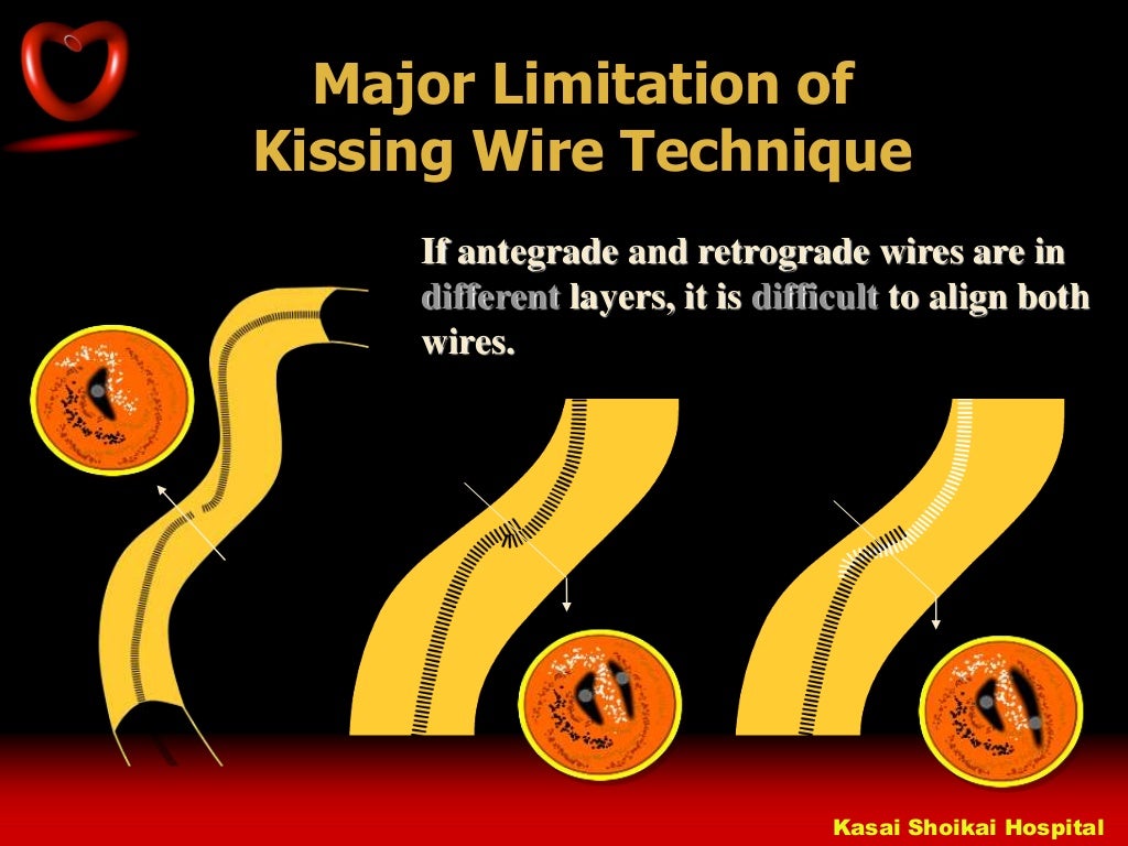0830 Asakura How to Succeed in Reverse CART Technique