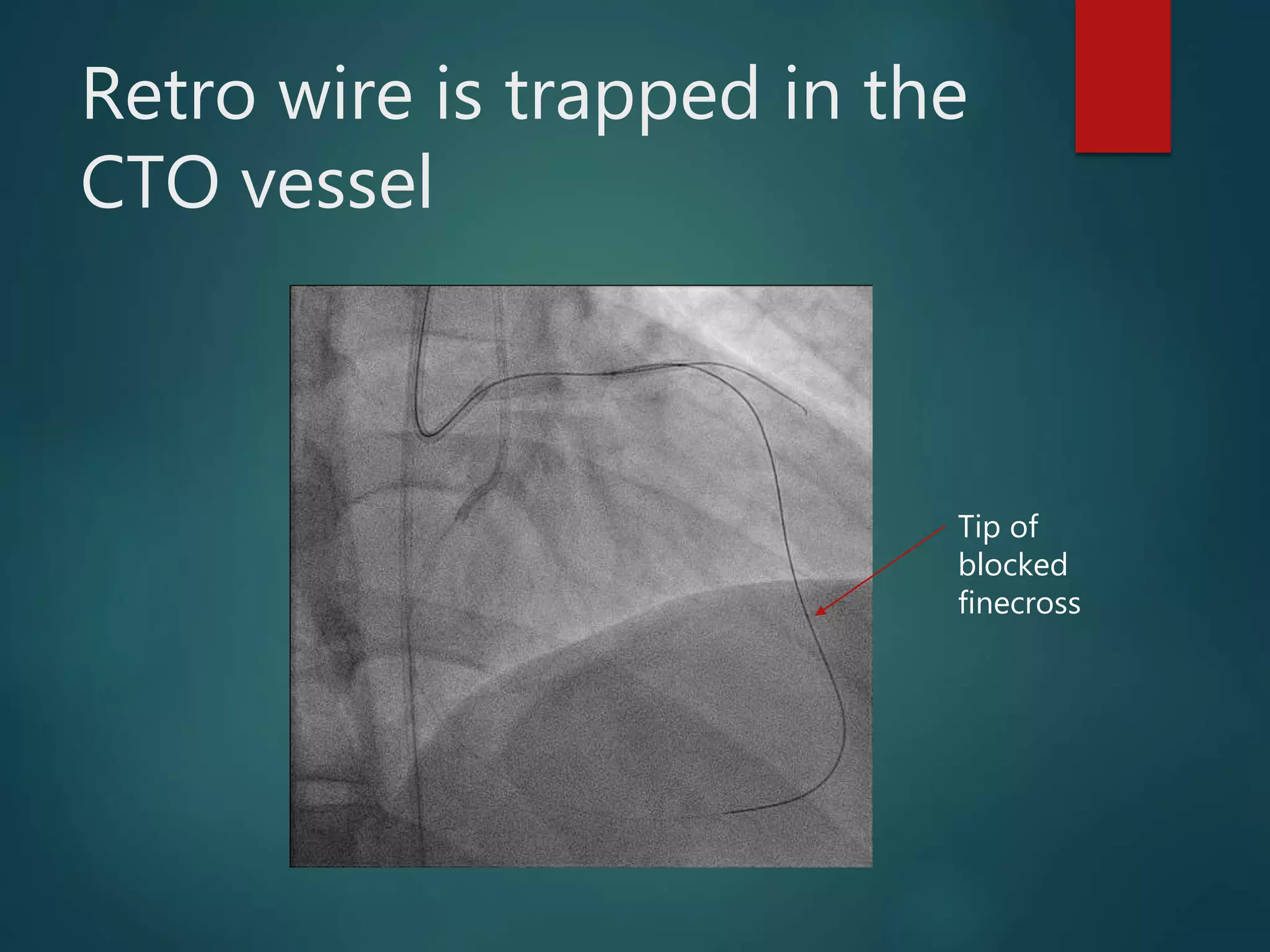 Rapid fire Tipps and Tricks – 5 min: What do do if …microcatheter ...