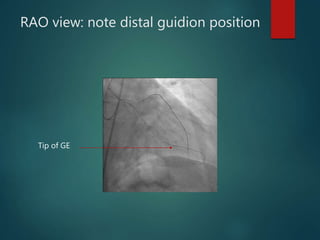 Rapid fire Tipps and Tricks – 5 min: What do do if …microcatheter ...