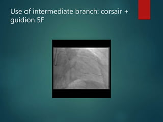 Rapid fire Tipps and Tricks – 5 min: What do do if …microcatheter ...