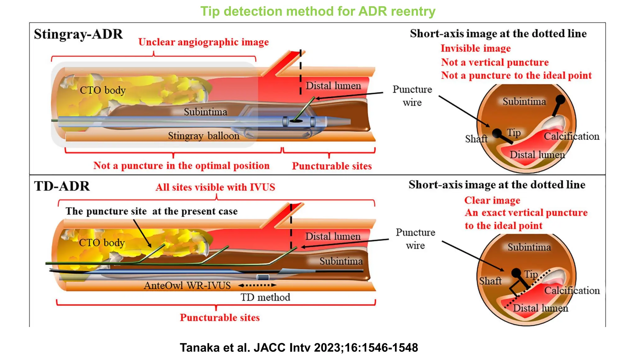 Tanaka et al. JACC Intv 2023;16:1546-1548
Tip detection method for ADR reentry
 