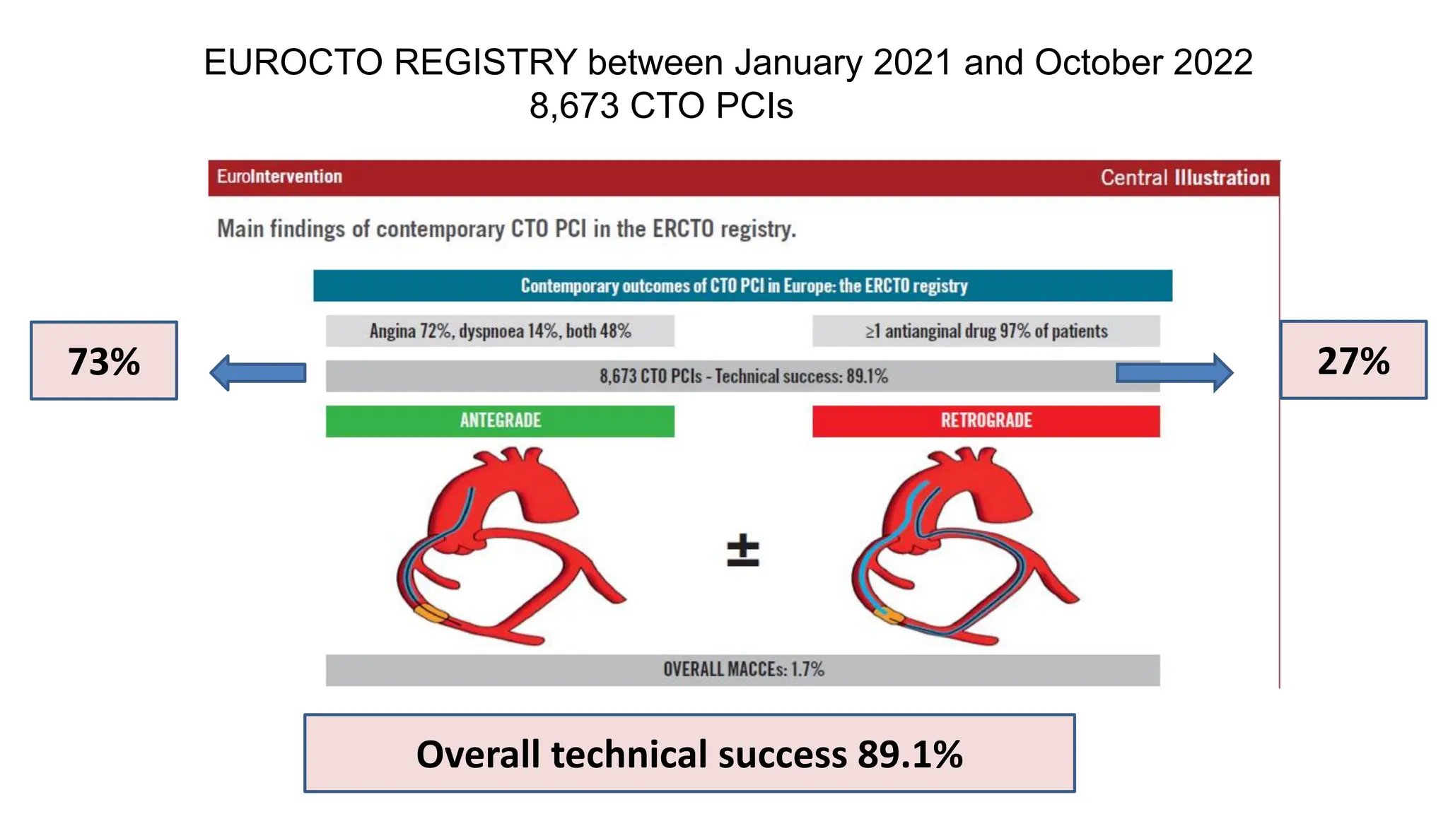 73% 27%
Overall technical success 89.1%
EUROCTO REGISTRY between January 2021 and October 2022
8,673 CTO PCIs
 