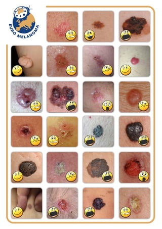 Euromelanoma table of lesions