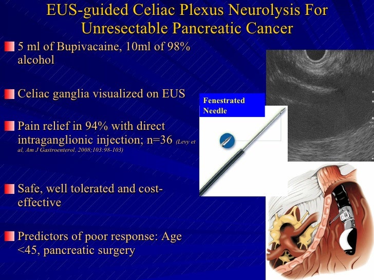 EUS Guided Anti Tumor Therapyversion0