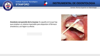Carrera: Técnico Superior en Odontología
INSTRUMENTAL DE ODONTOLOGIA
2
Anestesia con punción de la mucosa: Es aquella en la que hay
que emplear un sistema inyectable para depositar el fármaco
anestésico y así lograr su efecto.
 