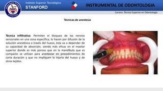 Carrera: Técnico Superior en Odontología
INSTRUMENTAL DE ODONTOLOGIA
2
Técnicas de anestesia
Técnica infiltrativa: Permiten el bloqueo de los nervios
sensoriales en una zona específica, lo hacen por difusión de la
solución anestésica a través del hueso, ésta va a depender de
su capacidad de absorción, siendo más eficaz en el maxilar
superior donde es más poroso que en la mandíbula que es
compacto se utilizan para anestesiar en procedimientos de
corta duración y que no impliquen la injuria del hueso y de
otros tejidos.
 