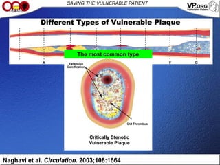 Naghavi et al. Circulation. 2003;108:1664
The most common type
 