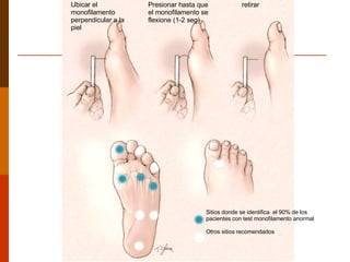 Ubicar el monofilamento perpendicular a la piel Presionar hasta que el monofilamento se flexione (1-2 seg) retirar Sitios donde se identifica  el 90% de los pacientes con test monofilamento anormal Otros sitios recomendados 