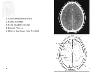 1. Cisura Interhemisférica 
2. Hueso Parietal. 
3. Seno Sagital Superior 
4. Lobulo Parietal 
5. Centro Semioval (lob. Frontal). 
 