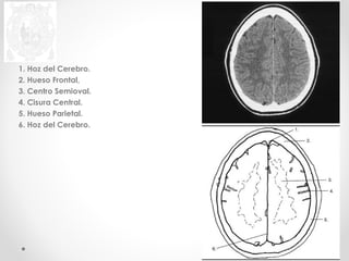 1. Hoz del Cerebro. 
2. Hueso Frontal, 
3. Centro Semioval. 
4. Cisura Central. 
5. Hueso Parietal. 
6. Hoz del Cerebro. 
 