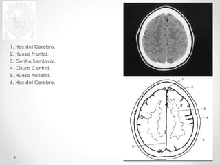 1. Hoz del Cerebro. 
2. Hueso Frontal. 
3. Centro Semioval. 
4. Cisura Central. 
5. Hueso Parietal. 
6. Hoz del Cerebro. 
 