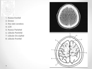1. Hueso frontal 
2. Grasa 
3. Hoz del cerebro 
4. LCR 
5. Hueso Parietal 
6. Lóbulo Parietal 
7. Lóbulo Occipital 
8. Lóbulo Frontal 
 