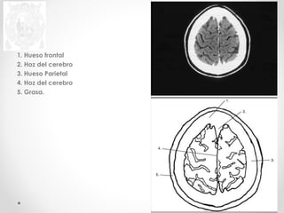 1. Hueso frontal 
2. Hoz del cerebro 
3. Hueso Parietal 
4. Hoz del cerebro 
5. Grasa. 
 