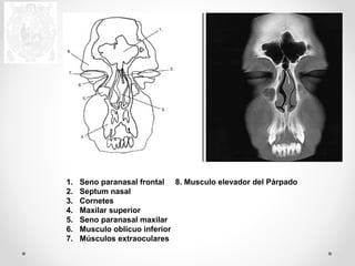 1. Seno paranasal frontal 8. Musculo elevador del Párpado 
2. Septum nasal 
3. Cornetes 
4. Maxilar superior 
5. Seno paranasal maxilar 
6. Musculo oblicuo inferior 
7. Músculos extraoculares 
 