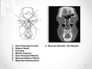 1. Seno Paranasal Frontal. 8. Musculo Elevador del Párpado. 
2. Septum Nasal. 
3. Cornetes. 
4. Maxilar Superior. 
5. Seno Paranasal Maxilar. 
6. Musculo Oblicuo Inferior. 
7. Músculos Extraoculares. 
 